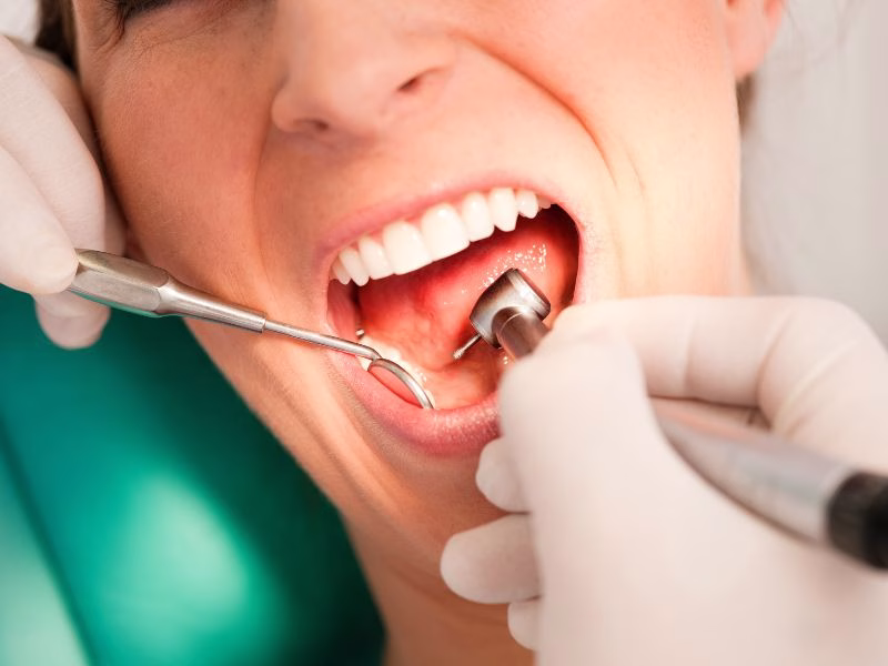Limpieza dental