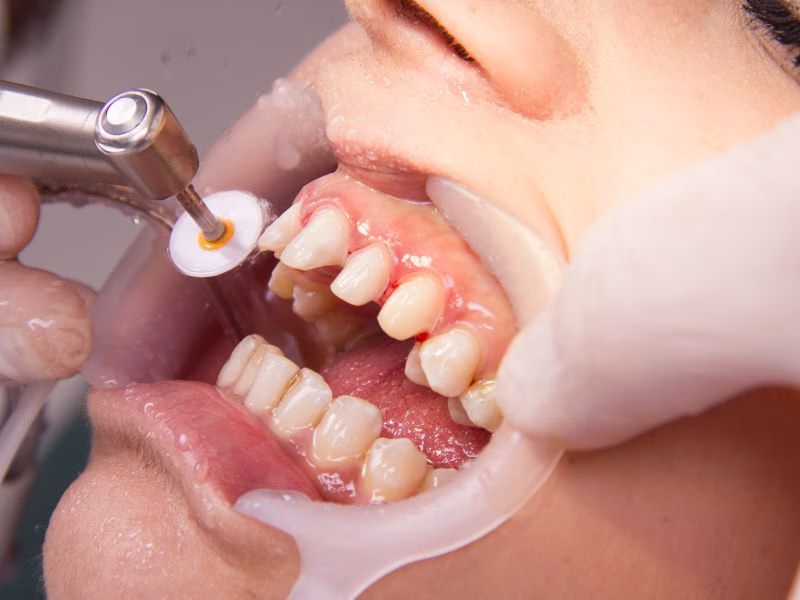 Limpieza dental