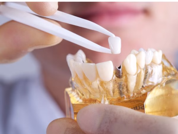 implantes